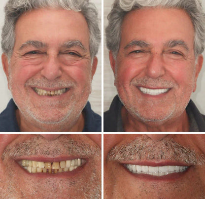 🔥🔥50% off on amazing smile products! Customizable functional dentures🦷