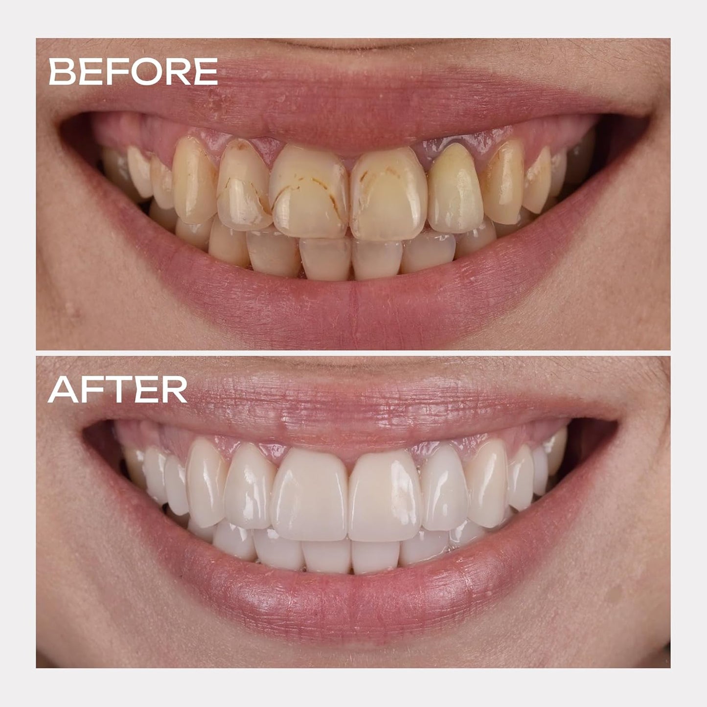 🔥🔥50% off! Purple Light Toothpaste whitens skin tone in 3 days ⚡