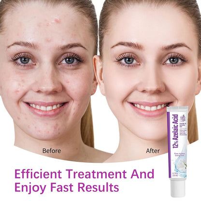 🔥🔥50% off microdermabrasion serum 💧 No redness on sensitive skin, no photorejuvenation