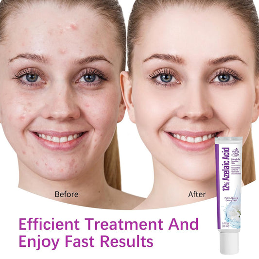 🔥🔥50% off microdermabrasion serum 💧 No redness on sensitive skin, no photorejuvenation