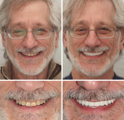 🔥🔥50% off on amazing smile products! Customizable functional dentures🦷