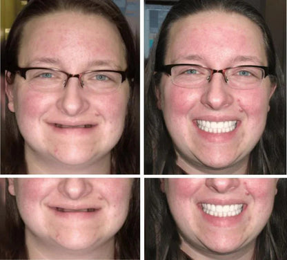 🔥🔥50% off on amazing smile products! Customizable functional dentures🦷