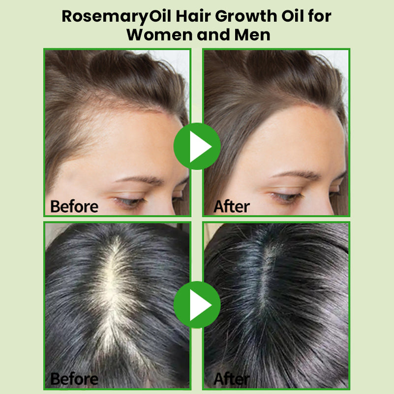 💇‍♀️Worried about baldness? 💧50% off Rosemary Hair Growth Oil to awaken your hair follicles! 🔥