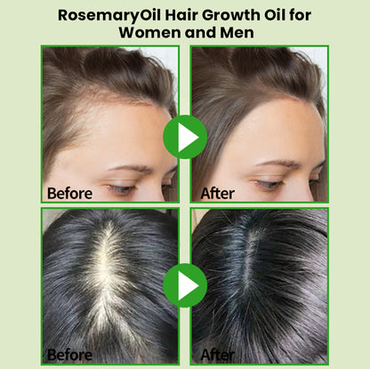 💇‍♀️Worried about baldness? 💧50% off Rosemary Hair Growth Oil to awaken your hair follicles! 🔥