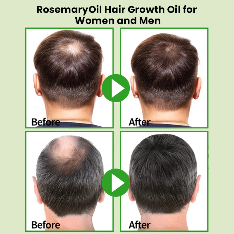 💇‍♀️Worried about baldness? 💧50% off Rosemary Hair Growth Oil to awaken your hair follicles! 🔥