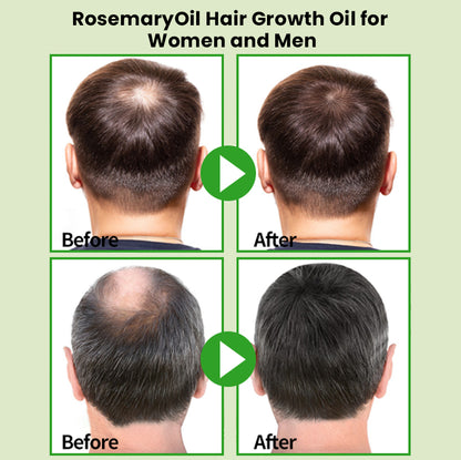 💇‍♀️Worried about baldness? 💧50% off Rosemary Hair Growth Oil to awaken your hair follicles! 🔥