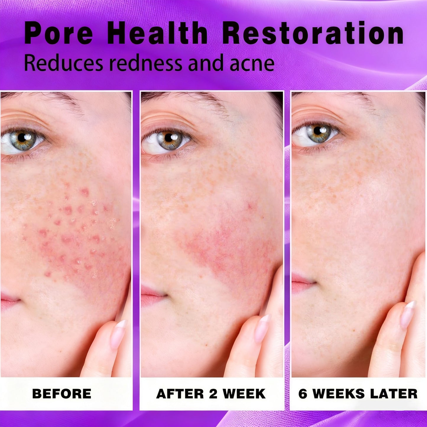 🔥🔥50% off microdermabrasion serum 💧 No redness on sensitive skin, no photorejuvenation