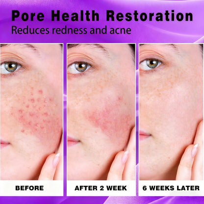 🔥🔥50% off microdermabrasion serum 💧 No redness on sensitive skin, no photorejuvenation