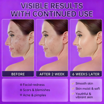 🔥🔥50% off microdermabrasion serum 💧 No redness on sensitive skin, no photorejuvenation