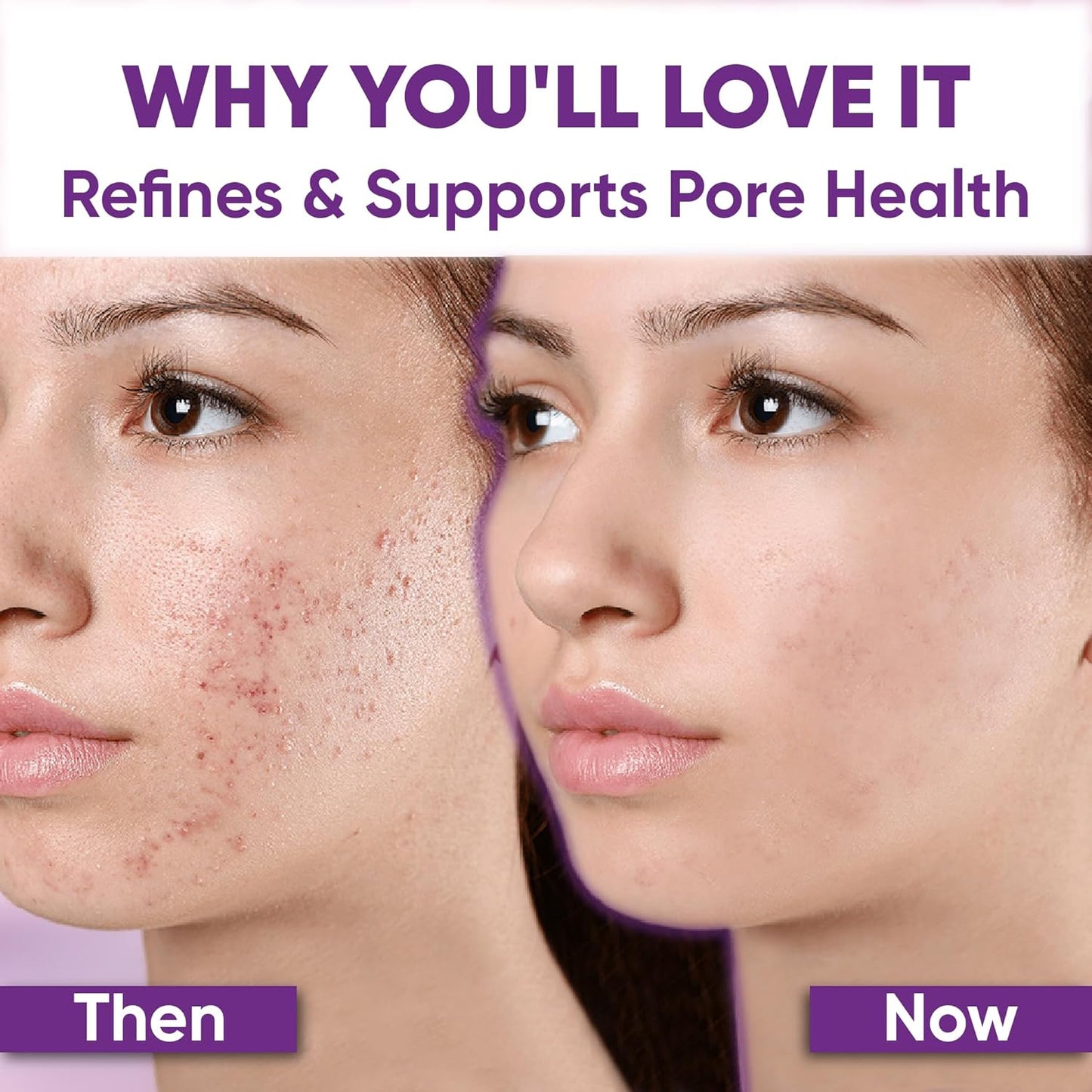 🔥🔥50% off microdermabrasion serum 💧 No redness on sensitive skin, no photorejuvenation