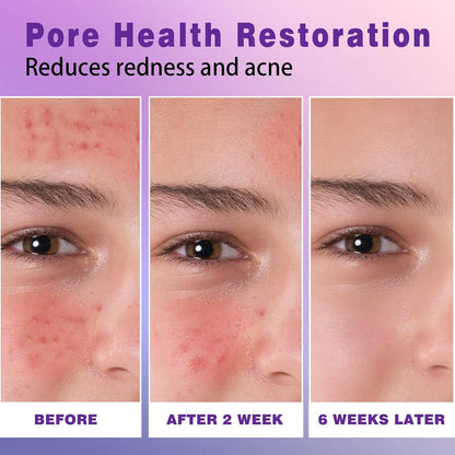 🔥🔥50% off microdermabrasion serum 💧 No redness on sensitive skin, no photorejuvenation