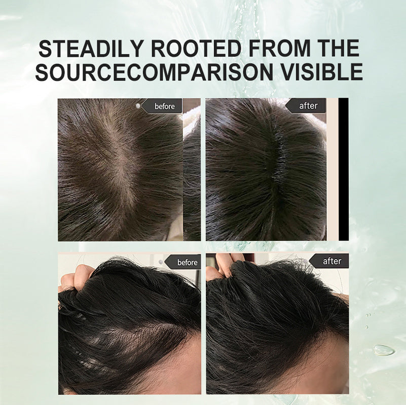 💇‍♀️Worried about baldness? 💧50% off Rosemary Hair Growth Oil to awaken your hair follicles! 🔥