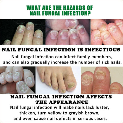 🌿Natural ginger essence! 🔥50% off on antibacterial and nail-nourishing products! 🔥