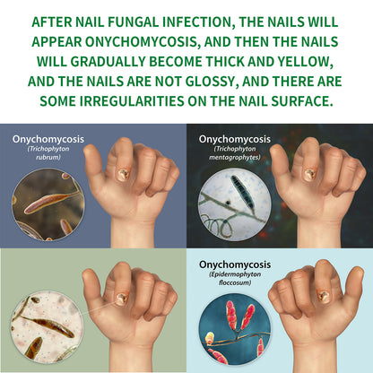 🌿Natural ginger essence! 🔥50% off on antibacterial and nail-nourishing products! 🔥