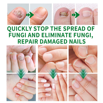 🌿Natural ginger essence! 🔥50% off on antibacterial and nail-nourishing products! 🔥