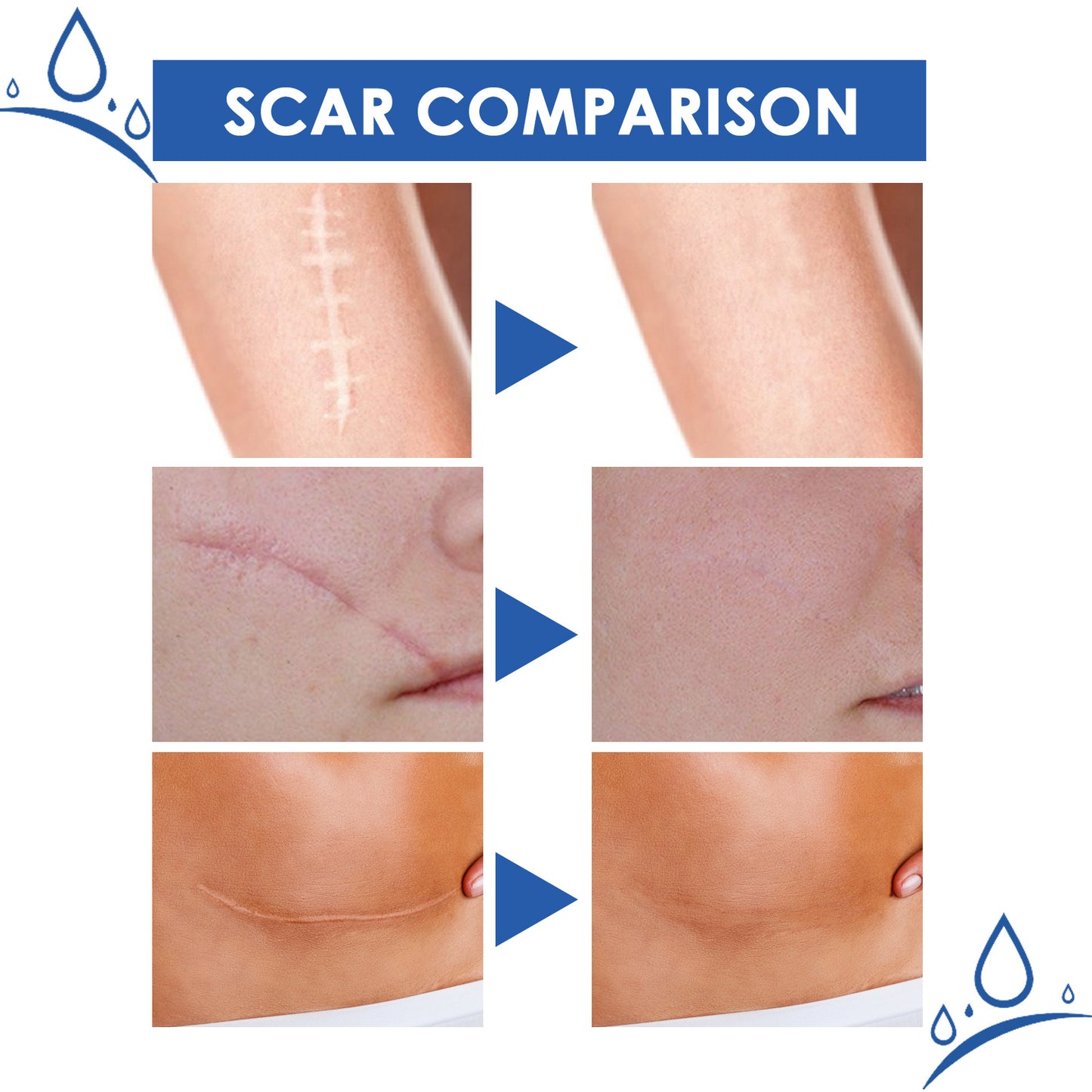 Ugly scars?？？ 🔥 50% off repair cream to smooth out blemishes! 🔥