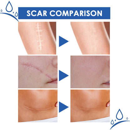 Ugly scars?？？ 🔥 50% off repair cream to smooth out blemishes! 🔥