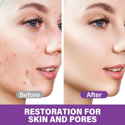 🔥🔥50% off microdermabrasion serum 💧 No redness on sensitive skin, no photorejuvenation